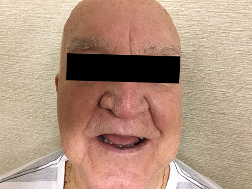 Superficial Radiotherapy After Photo